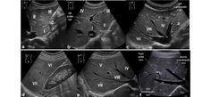 Liver Segments, Ob Ultrasound, Abdominal Ultrasound