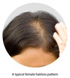 There are many causes of female hair loss, including pregnancy and menopause. We explore the reasons for hair loss in women and thinning hair here. Hair Growth Serums, Quick Hair Growth, Androgenic Alopecia, Hair Growth Cycle, Female Hair, Hair Control, Lost Hair, Easy Hair, Product Recommendations