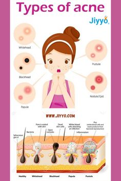 Papules Acne, Acne Pictures, Different Types Of Acne, Pimple Scars, Face Mapping, Types Of Acne, Acne Cream, Skin Repair, Facial Massage