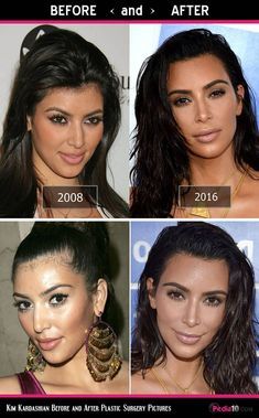 Kim Kardashian Nose, Kardashian Plastic Surgery, Kim Kardashian Eyebrows, Plastic Surgery Pictures, Kim Kardashian Before, Khloe Kardashian Hair, Facial Images, Rhinoplasty Nose Jobs, Celebrity Plastic Surgery