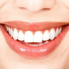 $78 for a Dental Package with Custom Bleaching Trays, Exam, and X-rays at Mission Boulevard Dental Group ($505 Value) White Teeth Overnight, Make Teeth Whiter, Kedokteran Gigi, Get Whiter Teeth, Laser Teeth Whitening, Straight Teeth, Church Logo, Teeth Implants, Tooth Enamel