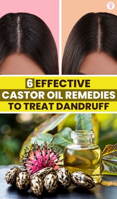 Dandruff is a hassle, making the scalp itchy and forcing you to avoid wearing your favorite black tops. Unfortunately, most anti-dandruff products contain chemicals that damage your hair health. A safer alternative is using a natural ingredient like castor oil for treating dandruff. #hair #haircare #beaurty #beautytips #colors #haircolors How To Avoid Dandruff, Castor Oil For Eyes, Treating Dandruff, Castor Oil For Acne, Treat Dandruff, Natural Dandruff Remedy, Prevent Dandruff, How To Treat Dandruff, Oils For Dandruff