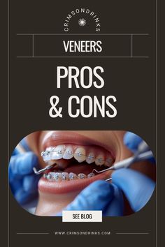 Dental veneers are thin shells attached to the front of teeth to enhance their appearance. They are commonly used to correct various dental issues such as discoloration, chips, gaps, and minor misalignment. Teeth Alignment, Discolored Teeth, Porcelain Veneers, Dental Veneers, Oral Hygiene, Pros And Cons, Oral Health