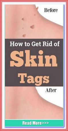 Amazing Advice-How To Get Rid Of - Mole, Skin tags And Scars Naturally? by daor lemor | This newsletter was created with Smore, an online tool for creating beautiful newsletters for educators, nonprofits, businesses and more Cold Medicine, Mole Removal, Get Rid Of Warts, Home Remedy For Cough, Skin Tags, Cold Sores Remedies, Weight Changes, Natural Cough Remedies, Cold Home Remedies