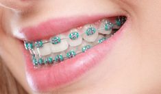 Dental Braces Colors, Braces Price, Braces Dentist, Cute Braces Colors, Dental Aesthetics, Laser Teeth Whitening