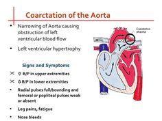 Pediatric Cardiovascular Disorders, Pediatric Cardiology, Coarctation Of The Aorta, Heart Mum, Nclex Review, Nursing Life, Cardiovascular Disorders, Heart Defect, Future Job