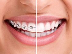 Lingual Braces, Traditional Braces, Clear Braces, Braces Colors, Dental Braces, Teeth Straightening, Metal Braces, Teeth Braces, Smile Makeover