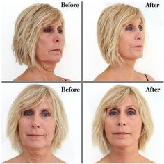 Haircuts For Fat Faces And Double Chins, Neck Lift Surgery, Saggy Neck, Neck Tightening, Thread Lift, Neck Exercises