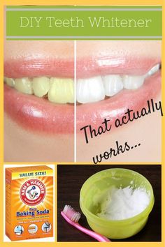 Make Teeth Whiter, Diy Teeth, Teeth Whitener, Yellow Teeth, Natural Teeth Whitening, Whitening Kit