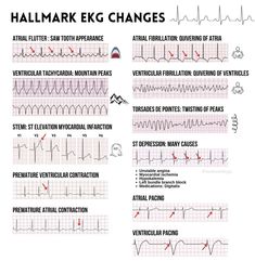 Ekg Notes, Ekg Interpretation Made Easy, Coronary Angiography, Medical Room, Emt Study, Er Tech, Cardiac Sonography, Ekg Interpretation, Ecg Interpretation