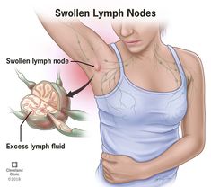 Swollen Lymph Nodes (Lymphadenopathy/Adenopathy): Symptoms & Causes Lymph Detox, Lymph Drainage Massage, Lymph Glands, Lymph Fluid, Lymph Massage, Lymph System, Lymph Drainage, Adipose Tissue, Lymph Nodes