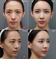 Fat Grafting Face, Fat Transfer To Face, Change Appearance, Face Fat, Fat Grafting, Fat Transfer, Nose Job