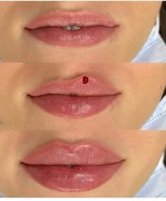 Lip Filler Inspiration Heart Shaped, Lip Injections Heart Shape, Keyhole Pout Lip Filler, Lip Injections Inspiration, Jolie Lip Filler, Lip Injection Inspiration, 1.5 Ml Lip Filler, Lip Filler Lips, 1ml Lip Filler Shapes