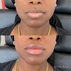 Lip Filler Technique, Lip Lift, Botox Before And After, Danielle Smith, Botox Lips, Body Makeover, Facial Fillers