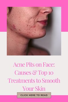 Acne Pits on Face: Causes & Top 10 Treatments to Smooth Your Skin Dark Eye Circles, Home Remedies For Acne, Healthier Skin, Diy Remedies, Acne Solutions, Dermatologist Recommended, Blackheads, Smooth Skin, Clear Skin