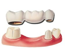 Dental #fillings and #crowns are the dental services for the overall makeover of your smile. Tooth Bridge