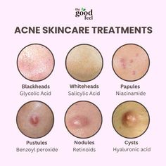 Unlock the secret to clearer skin with targeted treatments for every type of acne🌿 Active Acne Remedies, Dry And Acne Prone Skin, Face Problems Skin, Acne Breakout Chart, Acne Around Mouth And Chin, Reasons For Acne On Face, Skin Care For Sensitive Acne Prone Skin, Acne Placement, Skin Problems Face