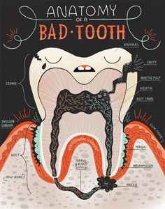 Dentaltown - Anatomy of a Tooth vs. Anatomy of a Bad Tooth Dental Assistant Study, Teeth Anatomy, Kedokteran Gigi, Dental Hygiene School, Teeth Art, Dental Anatomy, Dental Fun, Bad Teeth, Nice Teeth