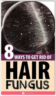 Smelly Scalp, Scalp Fungus, Smelly Hair, Ways To Grow Hair, Natural Dandruff Remedy, Fungal Infection Skin, Dandruff Remedy, Washing Your Hair, Fungal Infection