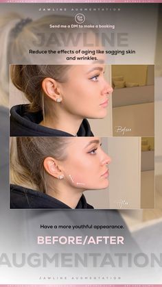 @Art_Face_Clinic Jawline perfect jawline face beautification dermal filler jawline contour define jawline jawline argumentation Define Jawline, Face Bloat, Jawline Contour, Slim Your Face, Perfect Jawline, Aesthetic Nurse, Lips