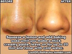 Skin Tips For Acne, Tips For Acne, Beauty Remedies, Diy Beauty Hacks, Mint Julep, Healthy Skin Care, My Chemical, Face Skin Care, Health And Beauty Tips