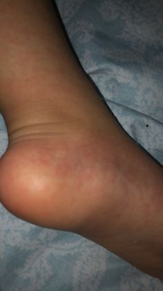 an image of a person with varicous on their leg and foot in bed