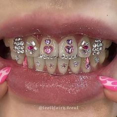 a woman with pink and white nails holding up her teeth to show the braces