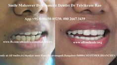 Dr Trivikram(Dr Vikram), an expert cosmetic dentist in Bangalore offers smile makeovers with #dentalveneers/crowns. Any adult having teeth with gaps, crooked teeth, oversized, small teeth, dark teeth, protruding or fractured teeth is a candidate for smile makeover. This treatment is not a surgery and your teeth can be straightened without braces/orthodontic treatment and can be finished in just 5-7 days in just 2-3 visits. Read more http://www.allsmilesdc.org/cosmetic-dentistry/ Cosmetic Dentistry Veneers, Loose Tooth, Oil Pulling