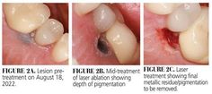 Amalgam Tattoo Removal Laser. There are any references about Amalgam Tattoo Removal Laser in here. you can look below. I hope this article about Amalgam Tattoo Removal Laser can be useful for you. Please remember that this article is for reference purposes only. #amalgam #tattoo #removal #laser Tattoo Removal Laser, Healthy Chicken Recipes, Chicken