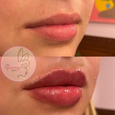 Juvederm Lips, 2021 Aesthetic, Lip Augmentation, Lip Enhancement, Lip Injections