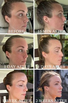 If you've ever wondered whether the MOXI Laser skin treatment is worth it, I'm sharing what it treats, the results, the down time, the cost, and my before and afters in this post. Laser Facial Before And After, Photofacial Before And After, Omnilux Before And After, Zo Skin Health Before And After, Moxi Laser Before And After, Fractional Laser Before After, Fraxel Laser Before And After, Facial Before And After, Face Laser