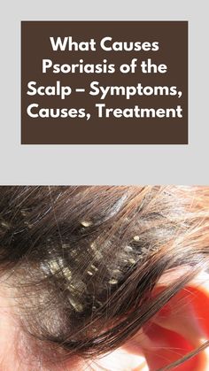 psoriasis of the scalp Itchy Scalp Remedy, Itchy Skin Remedy, Itchy Flaky Scalp, Dandruff Remedy, Flaky Scalp, Hair Control, Itchy Scalp, Hoco Makeup, Skin Remedies