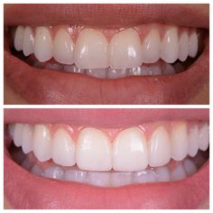 Teeth Aesthetic, Chipped Tooth, Teeth Dentist, Dental Braces