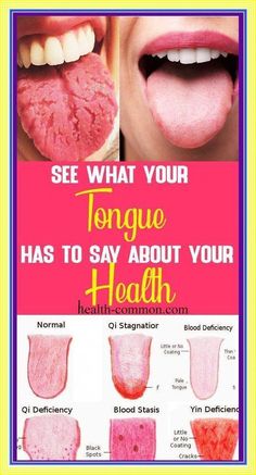 What Your Tongue is Trying to Tell  - You About Your Health  !!! by adeu borex | This newsletter was created with Smore, an online tool for creating beautiful newsletters for educators, businesses and more Tongue Scraper, Tongue Health, Health Signs, Nail Care Tips, Striped Nails, Nail Health, Black Spot, Health Problems, Natural Remedies