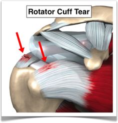 Rotator cuff injuries and rotator cuff tears are very common. Is surgery necessary for all rotator cuff tears? Usually the answer is no. Rotator Cuff, Shoulder Pain, Muscles, Surgery, Cuff