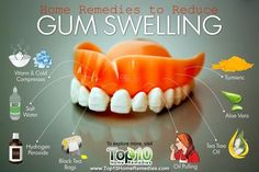 Swelling of the gums is a common problem. The tissue that forms the gums is thick, fibrous and full of blood vessels. Hence, when there is swelling, the gums may protrude or bulge out and appear red instead of their normal pink. This can cause the gums to become irritated, sensitive and even painful. The … Teeth Tips, Sensitive Teeth Remedy, Remedies For Tooth Ache, Swollen Gum, Top 10 Home Remedies, Best Teeth Whitening, Gum Care, Oil Pulling, Gum Health