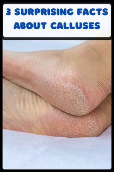 Did you know that calluses are your skin’s natural defense against friction? Discover 3 surprising facts about calluses, from how they can improve your grip to why they don’t hurt like normal skin. Learn how to care for calluses and keep your skin healthy! Electric Callus Remover, Callus Remover, Callus Removal, Normal Skin