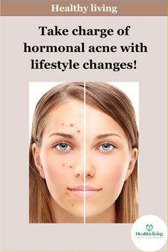 Hormonal imbalance can often be expressed as acne on the skin, particularly in the form of persistent and often frustrating hormonal acne. This type of acne is influenced by fluctuations in hormones, such as increased androgen levels. There are some medical treatments for hormonal acne but natural approaches help to maintain the hormonal equilibrium and promoting the clear skin. Hormonal Imbalance, Types Of Acne, Botanical Skincare, Hormonal Acne, Holistic Beauty, Skin Care Mask, Prevent Acne, Hormone Imbalance