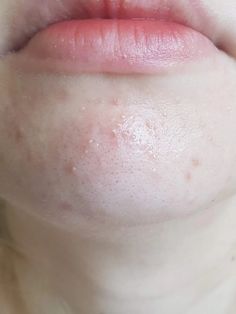 From Fungal Acne/Folliculitis to Clear Skin (with Pictures) | Skin Careless Acne Photos, Closed Comedones, Skin Picking Disorder, Skin Blackheads, Blind Pimple, Fungal Acne, Forehead Acne, Antifungal Cream, Pimples Under The Skin