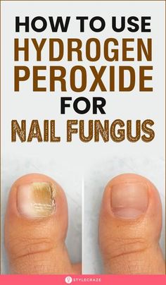 Penny Ball, Toenail Health, Nail Remedies, Toenail Fungus Remedies, Nail Fungus Remedy, Nail Infection, Holistic Diet, Fungal Nail, Home Health Remedies