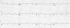 Inferior STEMI • LITFL • ECG Library Diagnosis St Elevation, Ecg Interpretation, Heart Blocks, Coronary Arteries, Acute Care, Assessment Tools, Chest Pain, Self Assessment, Mirror Image