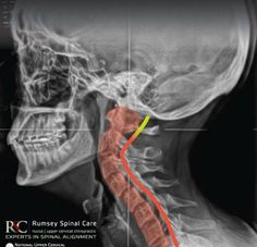 Neck Headache, Nervus Vagus, Forward Head Posture Exercises, Forward Head Posture, Nerve Health, Jaw Pain, Ear Health, Neurology, Health Info