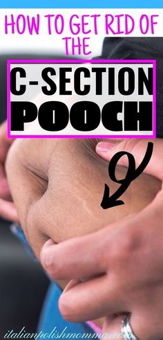 C Section Belly Get Rid Of, How To Get Rid Of C Section Pouch, Csection Pooch How To Get Rid, C Section Pooch Workout, How To Get Rid Of Lower Belly Pooch, C Section Pouch