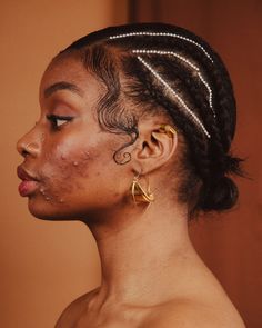 Refinery 29 | Why Aren't There More Black Dermatologists? Girl With Acne, Dark Skin Models, Hormonal Acne, Wearing All Black, Bare Face, Face Acne, Clear Acne, Raw Beauty