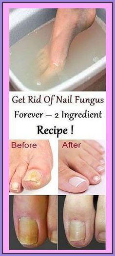 Natural Pedicure Ideas, Natural Pedicure, Toenail Health, Vinegar For Hair, 2 Ingredient Recipes, Pedicure Ideas, Baking Soda Vinegar, Fungal Nail, Baking Soda Uses