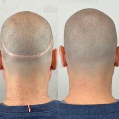 Bald Spot Hairstyles Men, Male Pattern Baldness In Women, Micro Scalp Pigmentation, Bald Head Tattoo, Scalp Micropigmentation, Bald Men Style