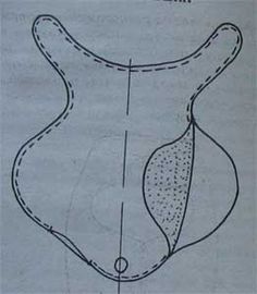 an image of a diagram of the back side of a woman's breast, with lines drawn on it