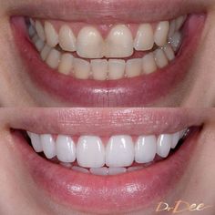 Before and after results of a patient's porcelain veneers done by Dr. Dee. Naturally Whiten Teeth, Cosmetic Dentistry Procedures, Facial Contouring, Laser Surgery