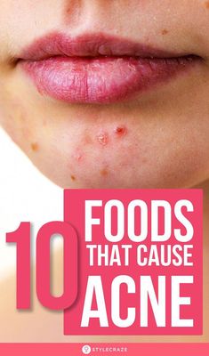 Though food alone cannot cause acne, certain foods can worsen the existing condition. Here are the foods that cause acne to worsen and foods for clear skin. Acne Causing Foods, Foods For Clear Skin, Natural Acne Remedies, Cold Sores Remedies, How To Get Rid Of Pimples, Natural Sleep Remedies