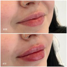 📍5098 Dundas St W Unit A, Etobicoke, ON  For all inquiries, contact us: 📞 289-834-9248 💌 info@plumpitupp.com  👩🏽‍💻 www.Plumpitupp.com 📸 @plumpitupp  #lipfillersbeforeandafter #lips #aesthetic #cosmetics #nurse #dermalfillers #beauty #fulllipsmakeup #1mllipfiller #selfcare Minimal Lip Fillers, 0.5 Lip Filler, 1ml Lip Filler Before And After, Lip Filler On Small Lips, 1 Ml Lip Filler, Natural Looking Lip Fillers, Lip Filler Styles, Lip Filler Natural, Subtle Lip Filler